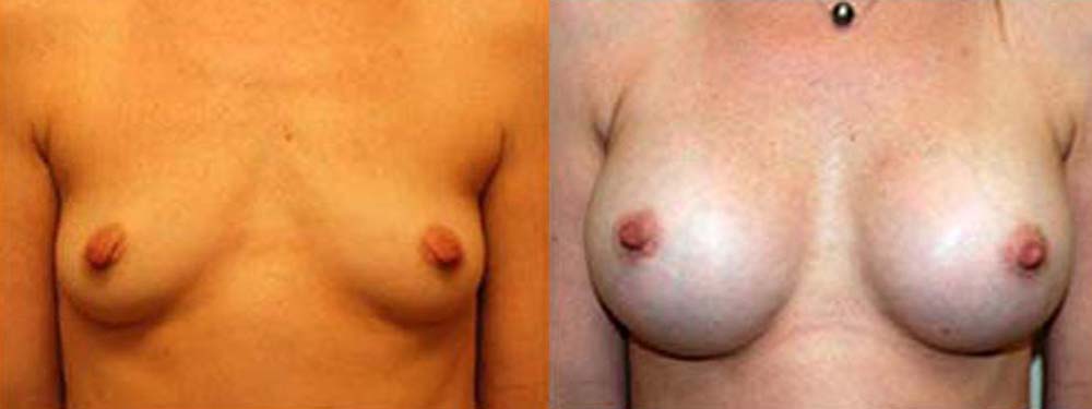 Breast Augmentation Before and After