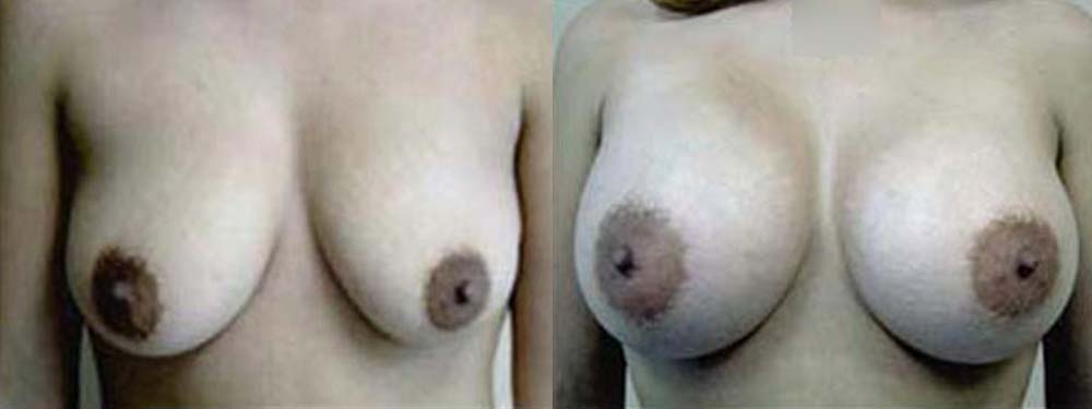 Breast Augmentation Before and After