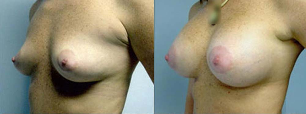 Breast Augmentation Before and After