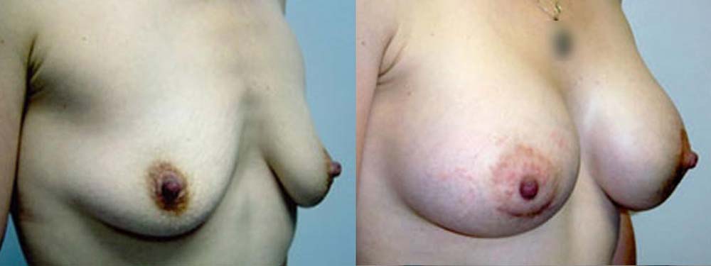 Breast Augmentation Before and After