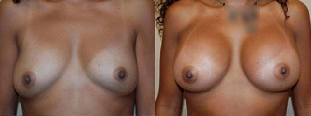 Breast Augmentation Before and After