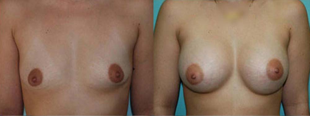 Breast Augmentation Before and After
