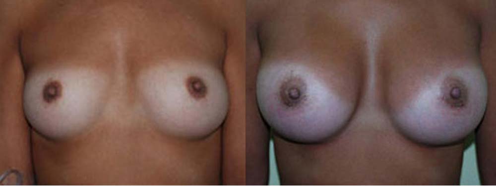 Breast Augmentation Before and After
