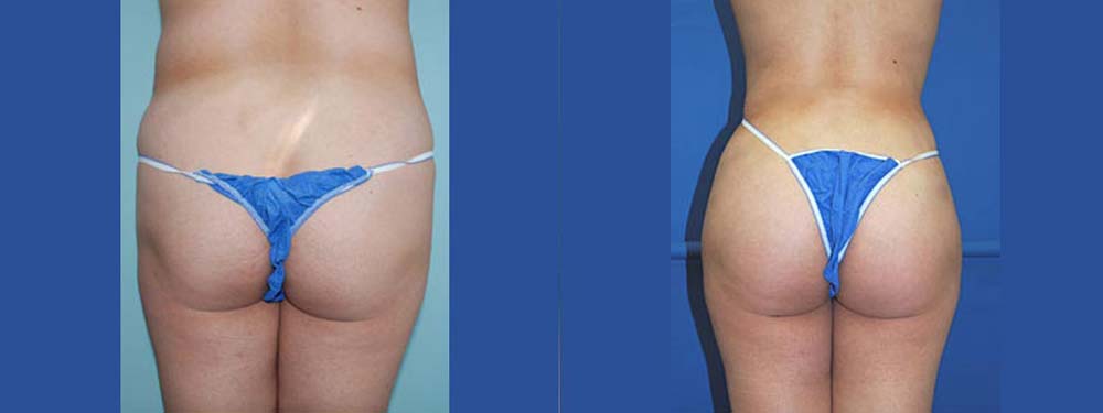 Brazilian Butt Lift Before and After