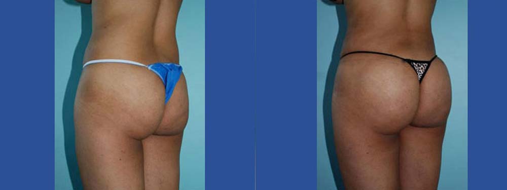 Brazilian Butt Lift Before and After