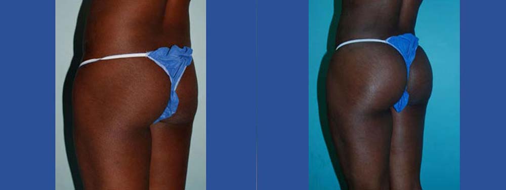 Brazilian Butt Lift Before and After
