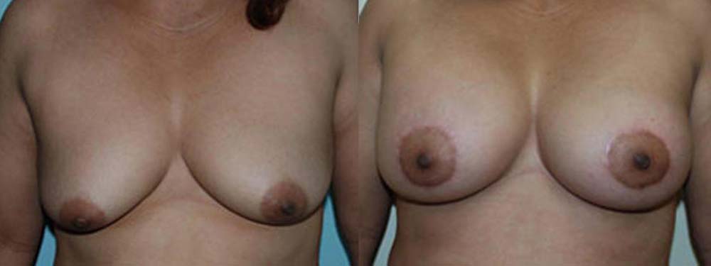 Beast Lift Before and After