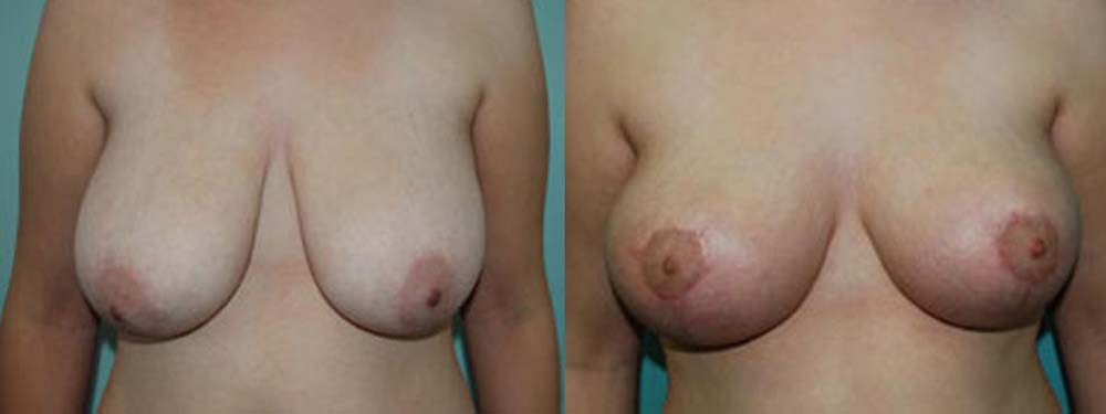 Breast Reduction Before and After