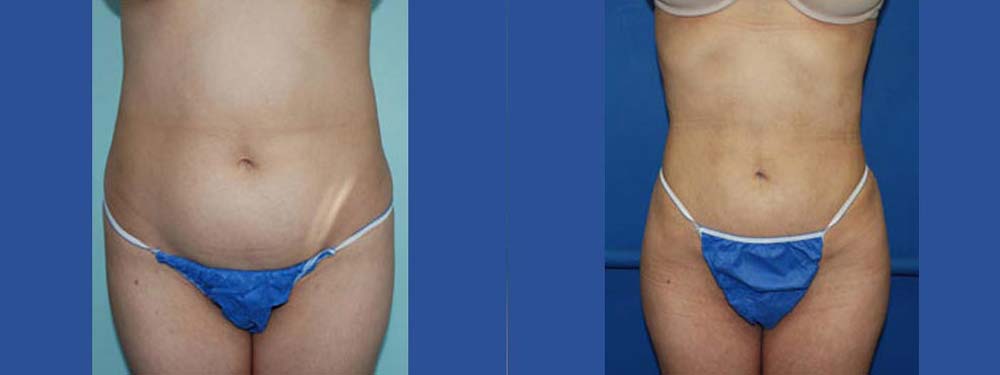 Liposuction Before and After