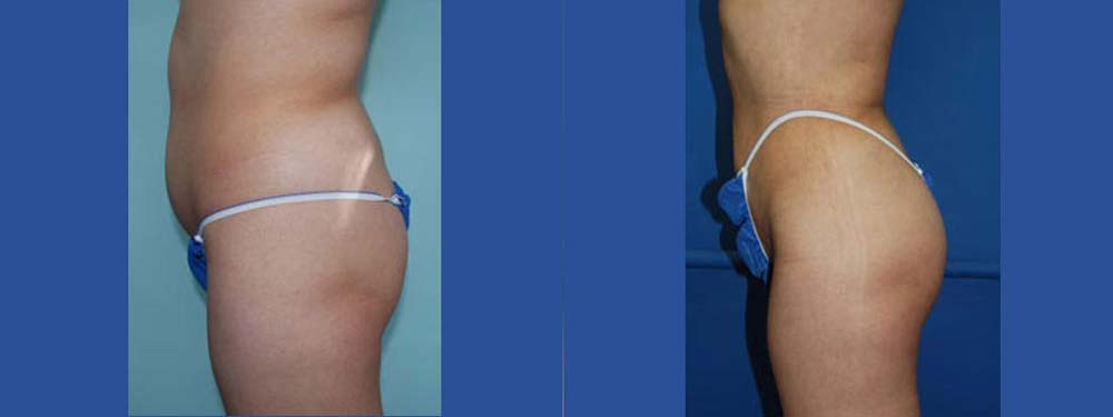 Liposuction Before and After