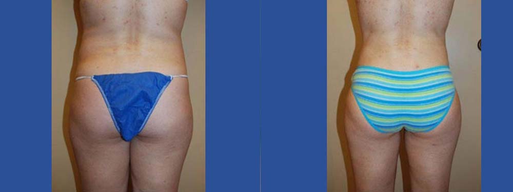 Liposuction Before and After