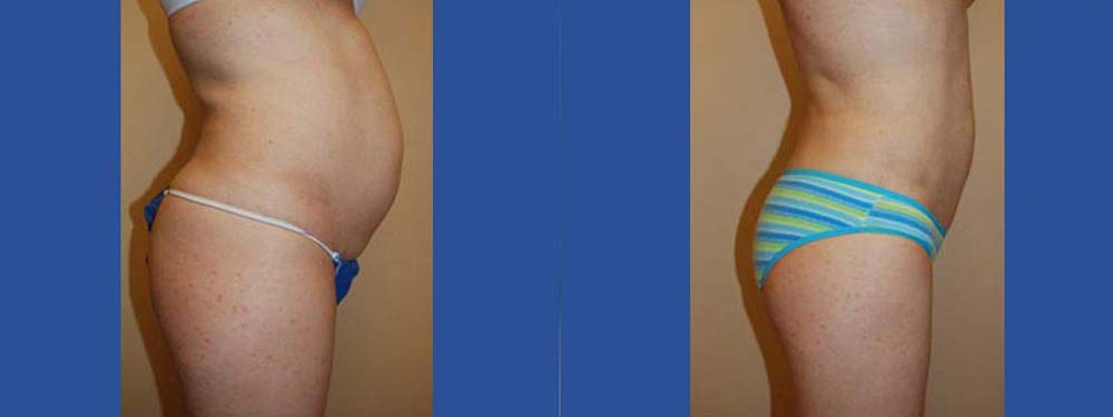 Liposuction Before and After