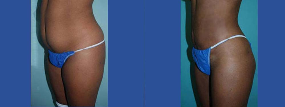 Liposuction Before and After