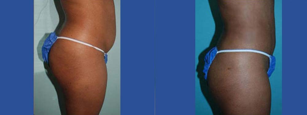 Liposuction Before and After