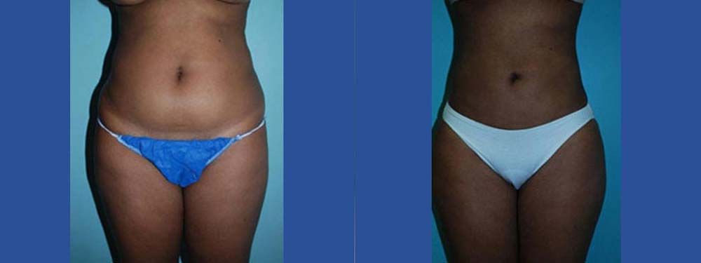 Liposuction Before and After