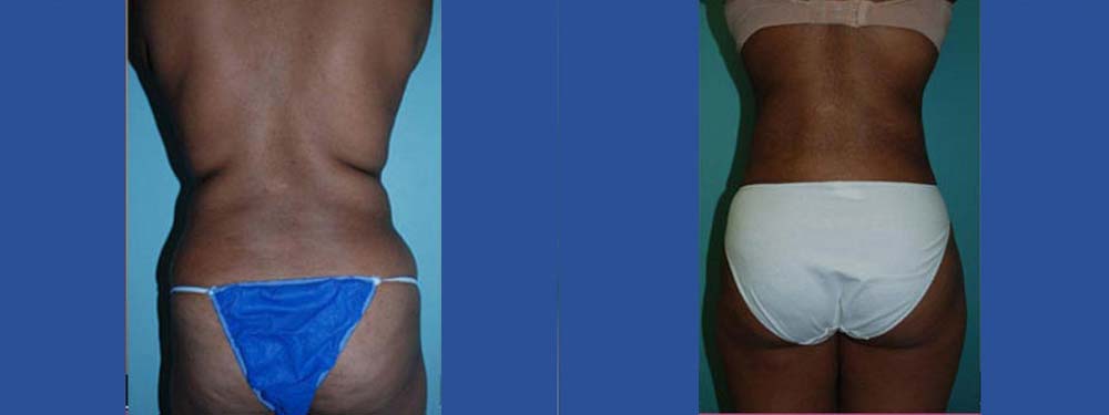 Liposuction Before and After
