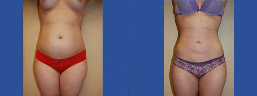 Liposuction Before and After