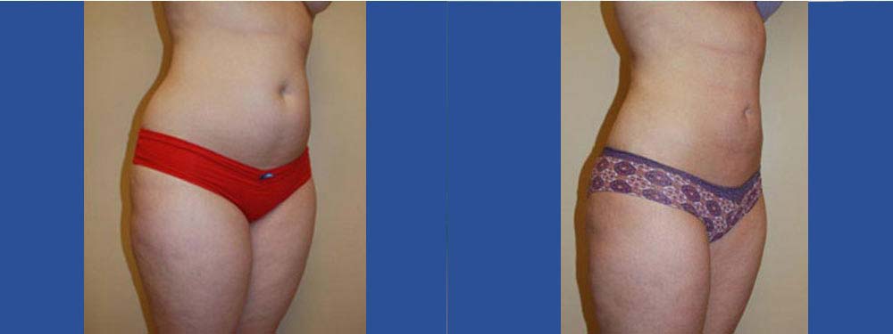 Liposuction Before and After