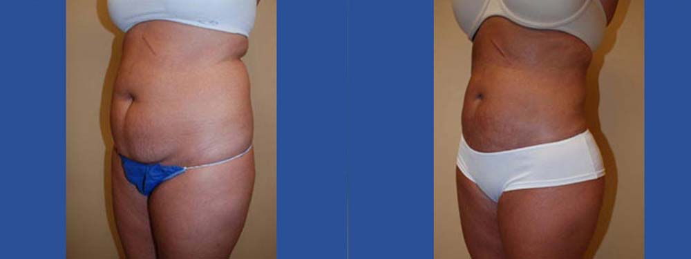 Liposuction Before and After