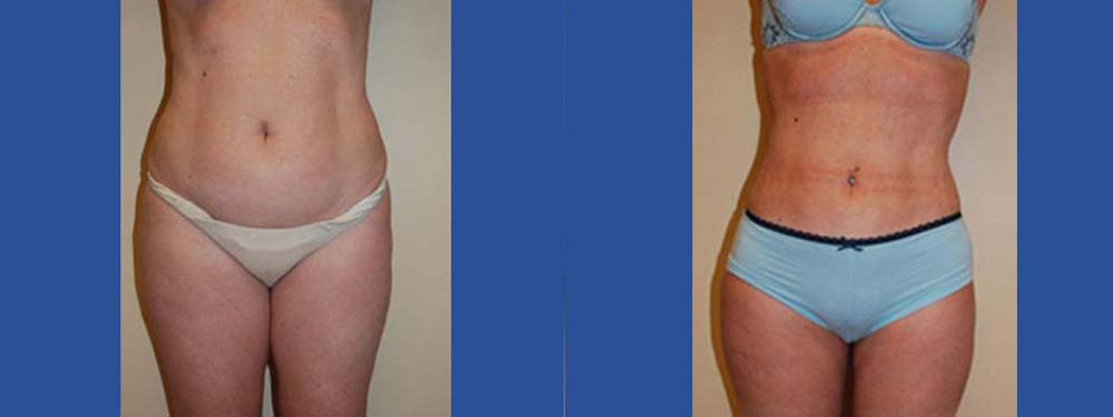 Liposuction Before and After