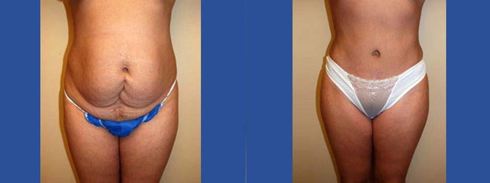 Tummy Tuck Abdominoplasty Before and After