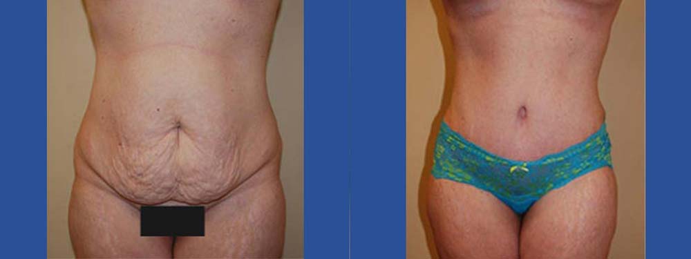 Tummy Tuck Abdominoplasty Before and After