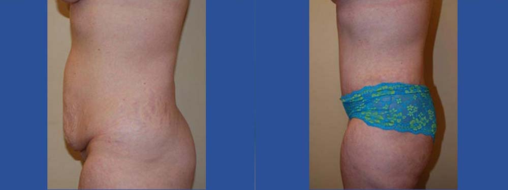 Tummy Tuck Abdominoplasty Before and After