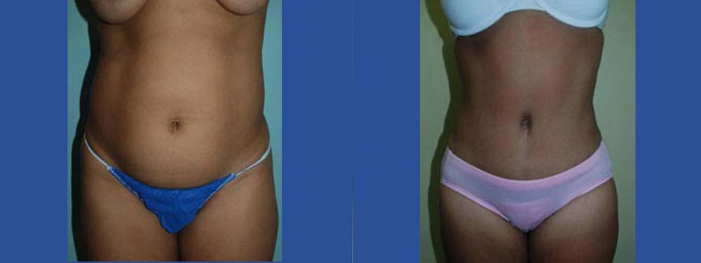 Tummy Tuck Abdominoplasty Before and After
