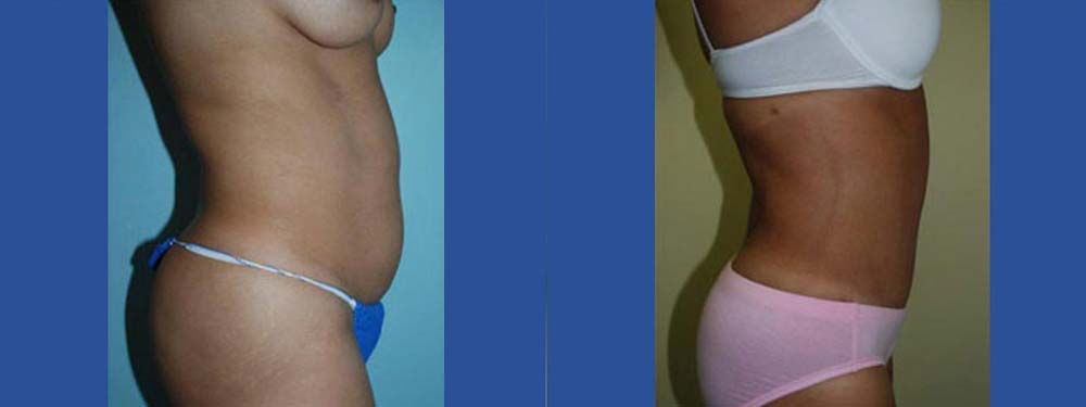 Tummy Tuck Abdominoplasty Before and After