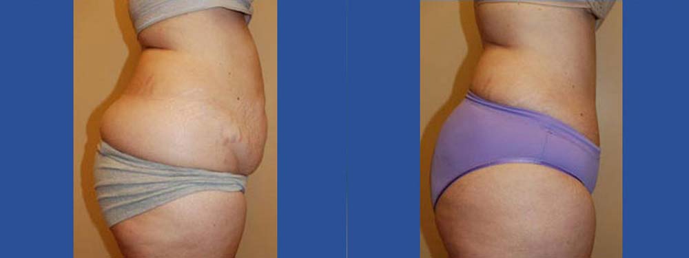 Tummy Tuck Abdominoplasty Before and After