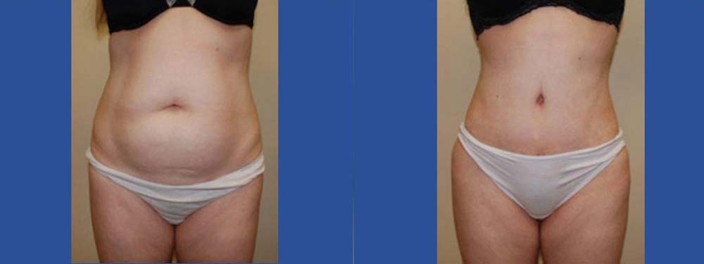 Tummy Tuck Abdominoplasty Before and After