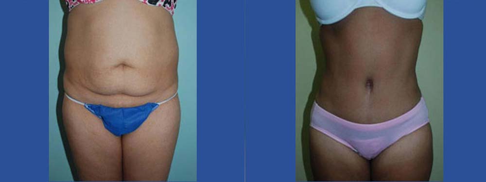 Tummy Tuck Abdominoplasty Before and After
