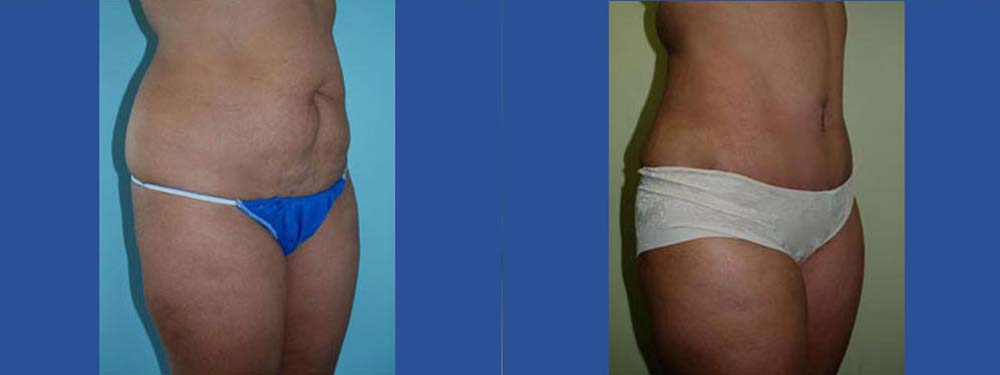 Tummy Tuck Abdominoplasty Before and After