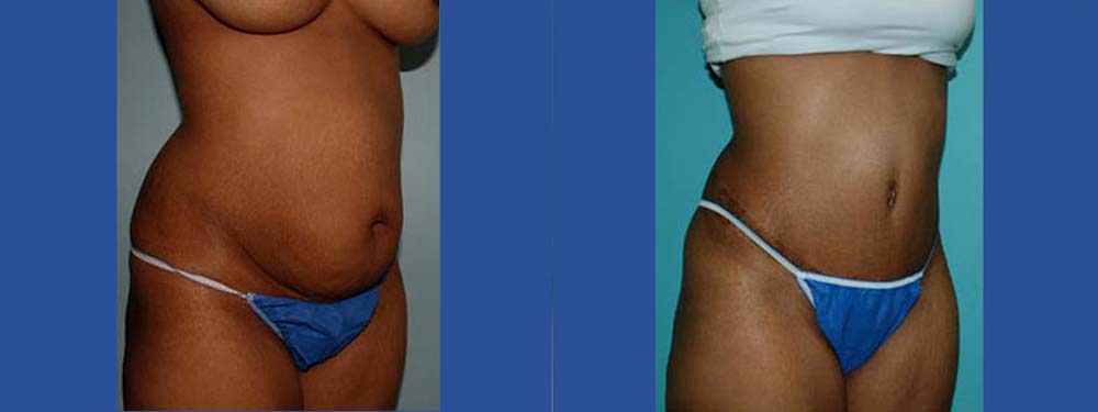Tummy Tuck Abdominoplasty Before and After