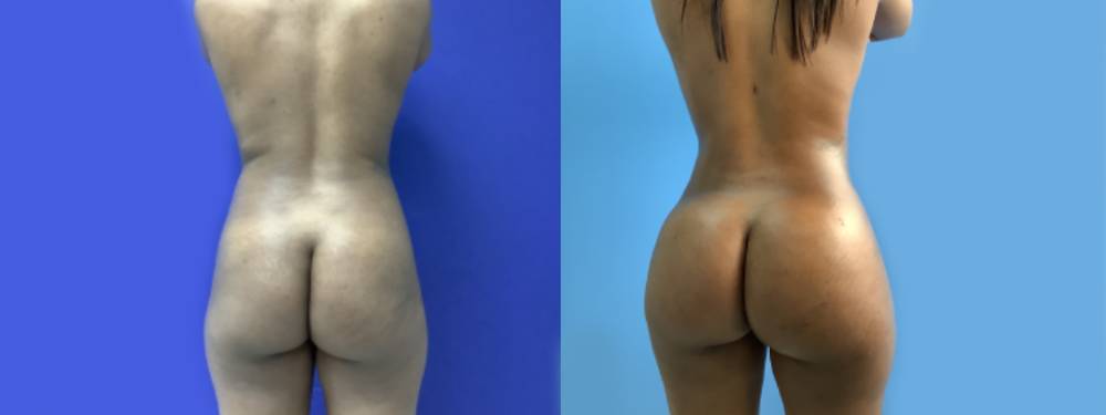 Brazilian Butt Lift Before and After in Miami