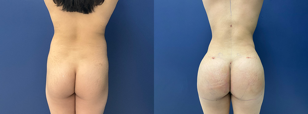 Male brazilian butt lift before and after