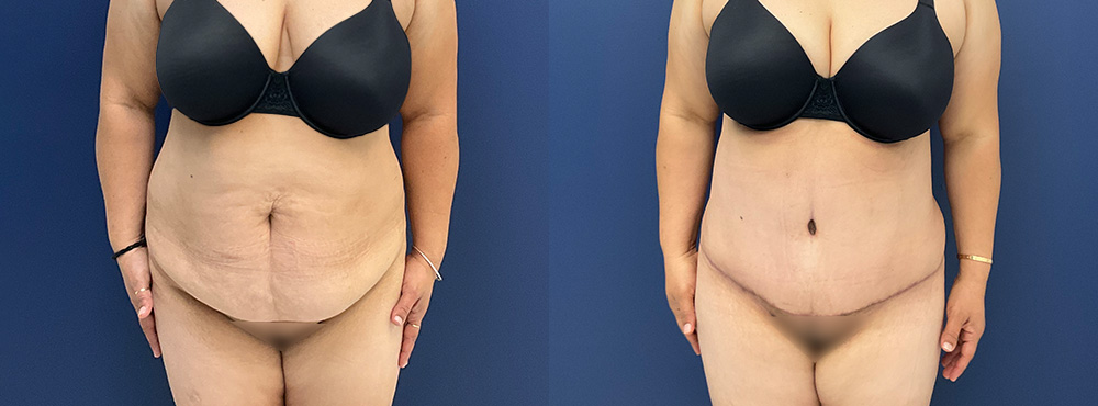 Tummy Tuck Before and After in Miami