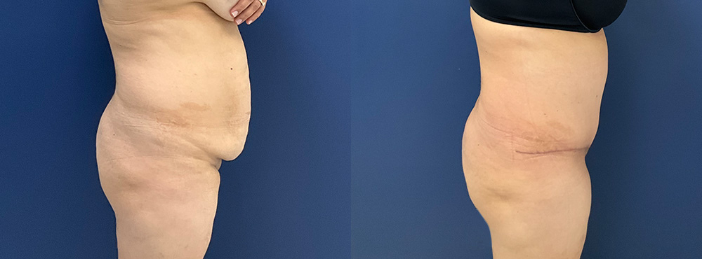 Tummy Tuck Before and After in Miami