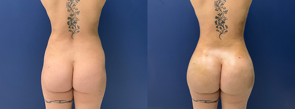Brazilian Butt Lift Before and After