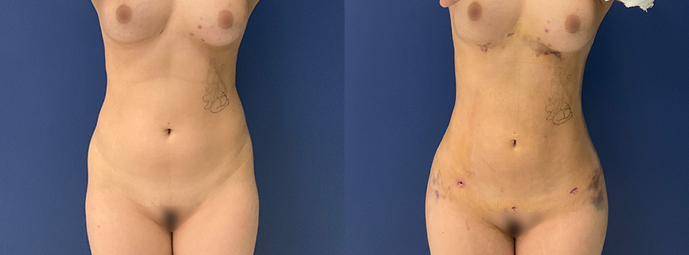 Brazilian Butt Lift Before and After