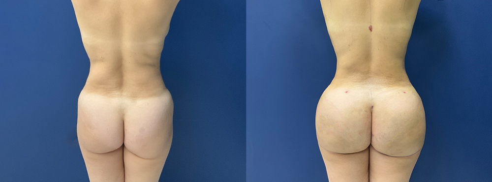 Brazilian Butt Lift before and after