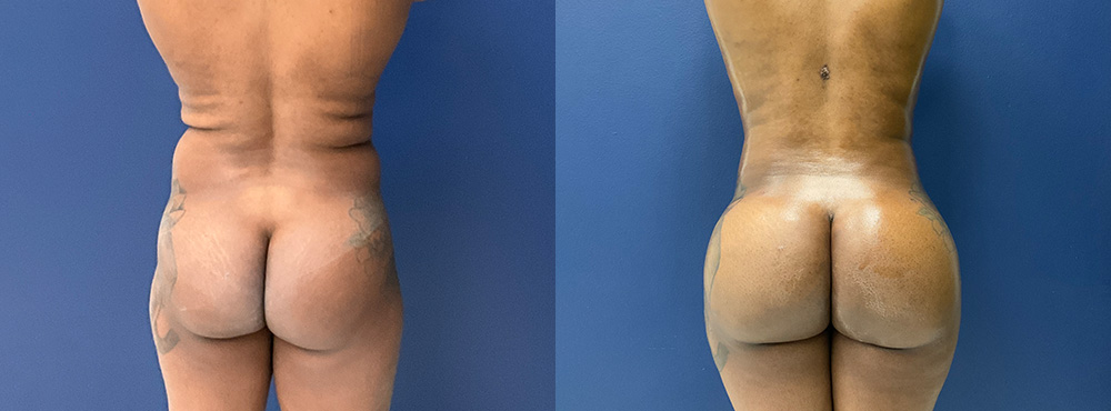 Brazilian Butt Lift before and after