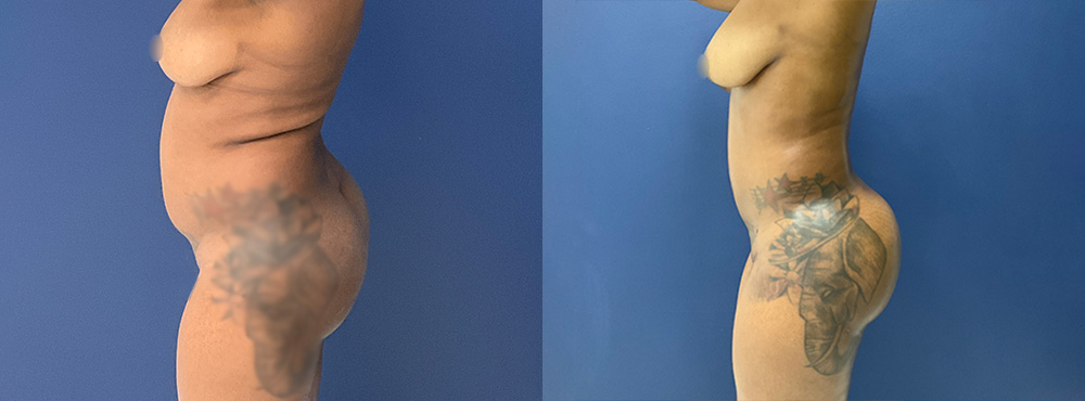 Brazilian Butt Lift before and after