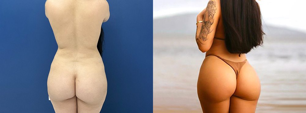 BBL Results fotos long term