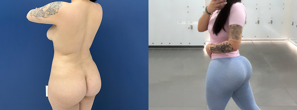 BBL Results fotos long term