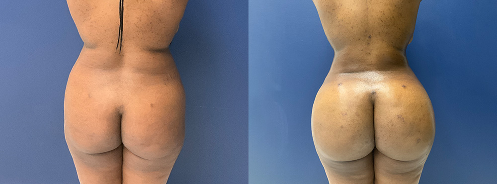 Brazilian Butt Lift Before and After