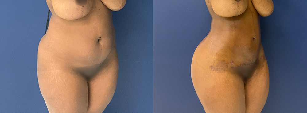 Brazilian Butt Lift Before and After