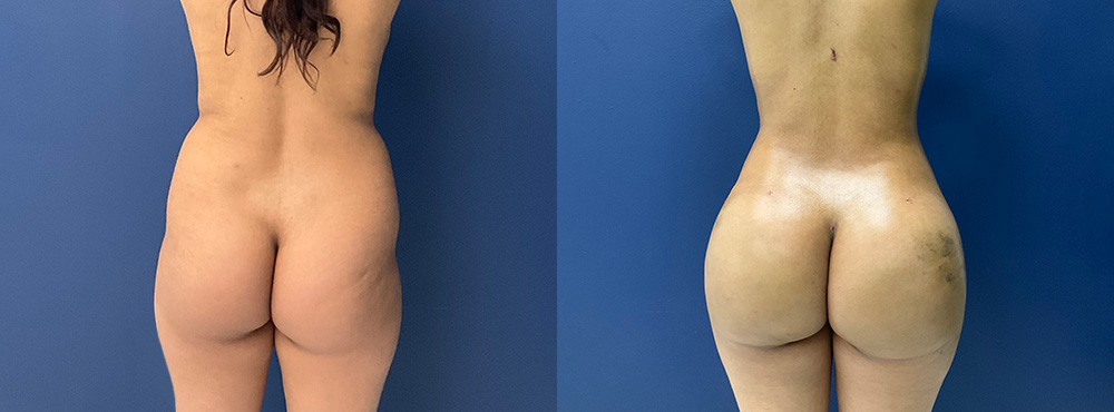 Brazilian Butt Lift before and after