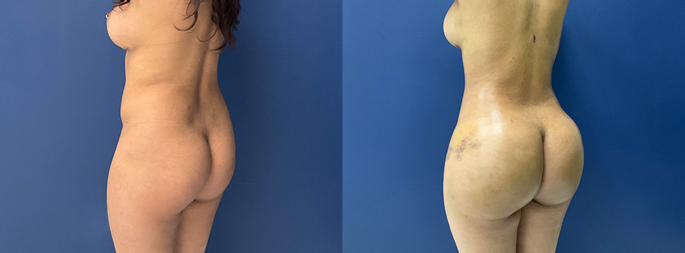 Brazilian Butt Lift before and after