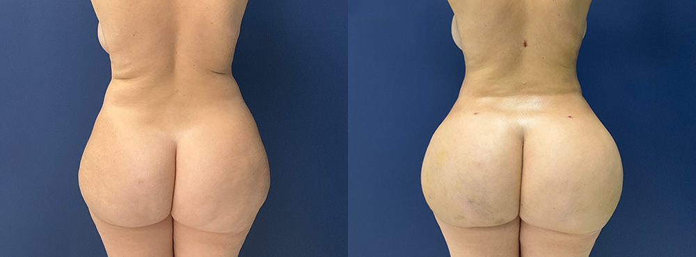 Brazilian Butt Lift Before and After